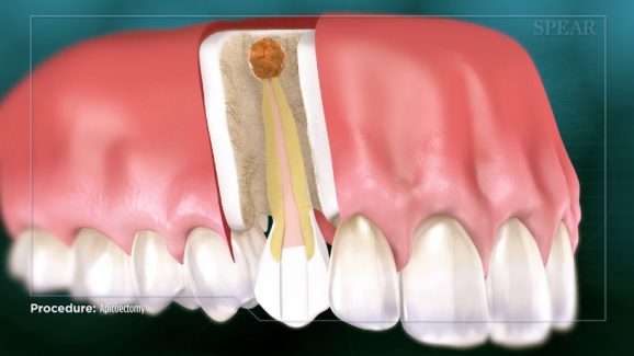 Apicoectomy - EOI NYC
