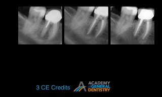 Why Do Endodontic Treatments Fail & How to Avoid Failures