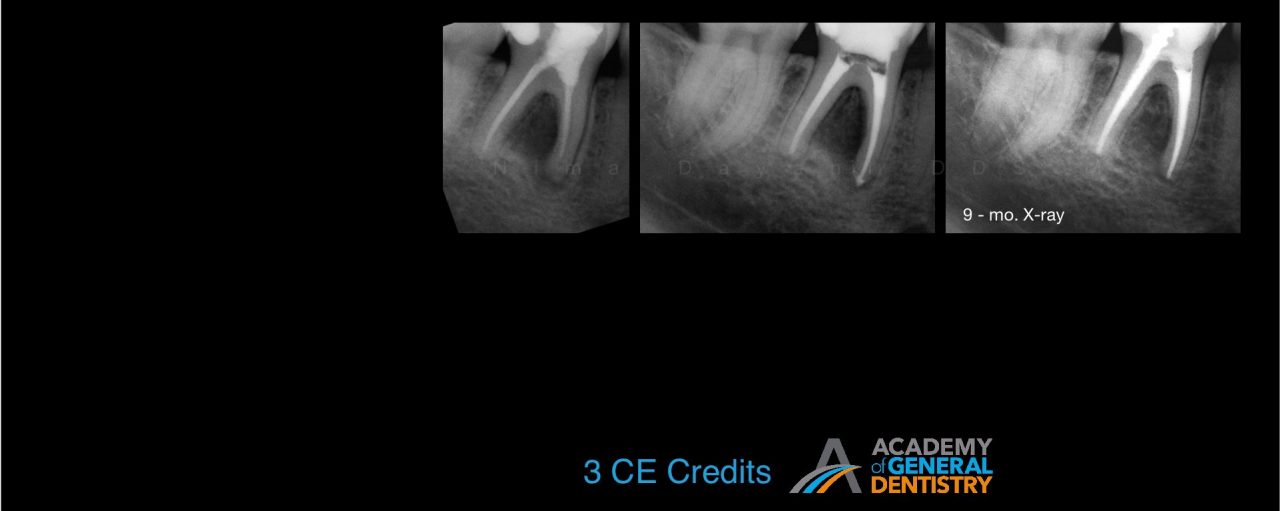 Why Do Endodontic Treatments Fail & How to Avoid Failures