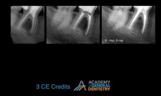 Why Do Endodontic Treatments Fail & How to Avoid Failures