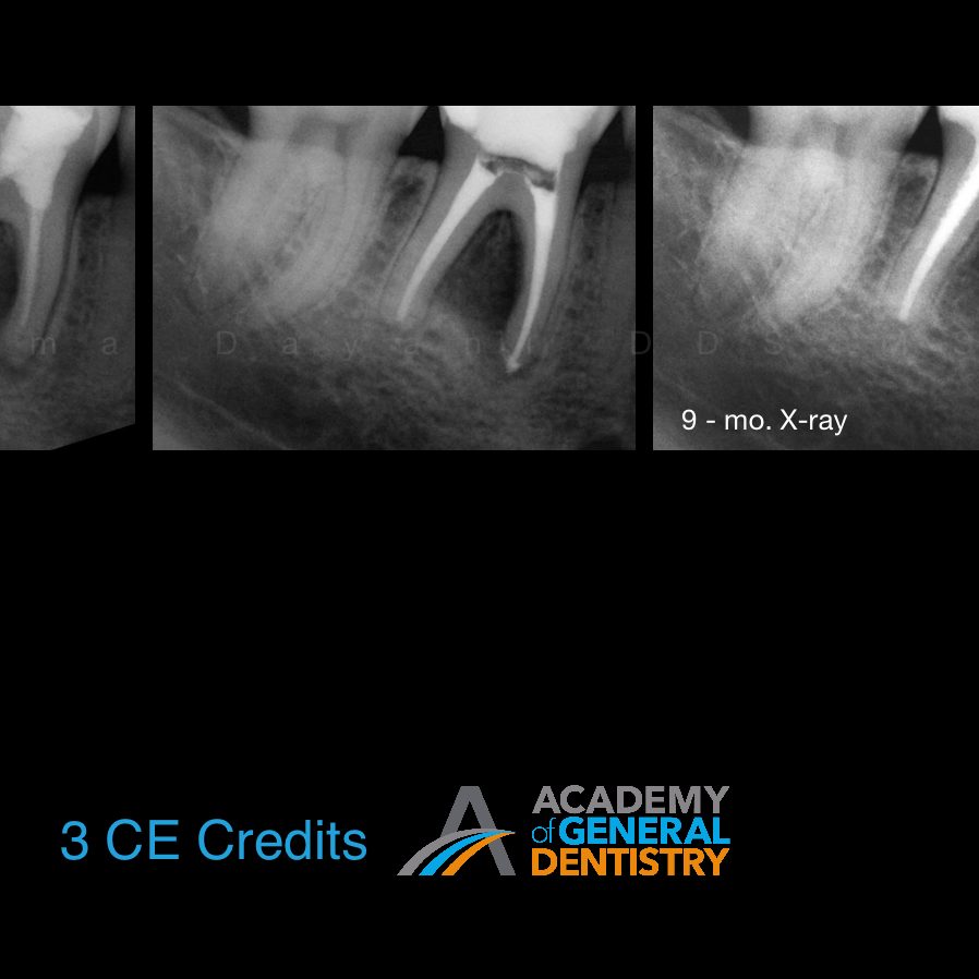 Pediatric Endodontics Regenerating Pulp in Necrotic Immature Permanent