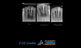 Why Do Endodontic Treatments Fail & How to Avoid Failures