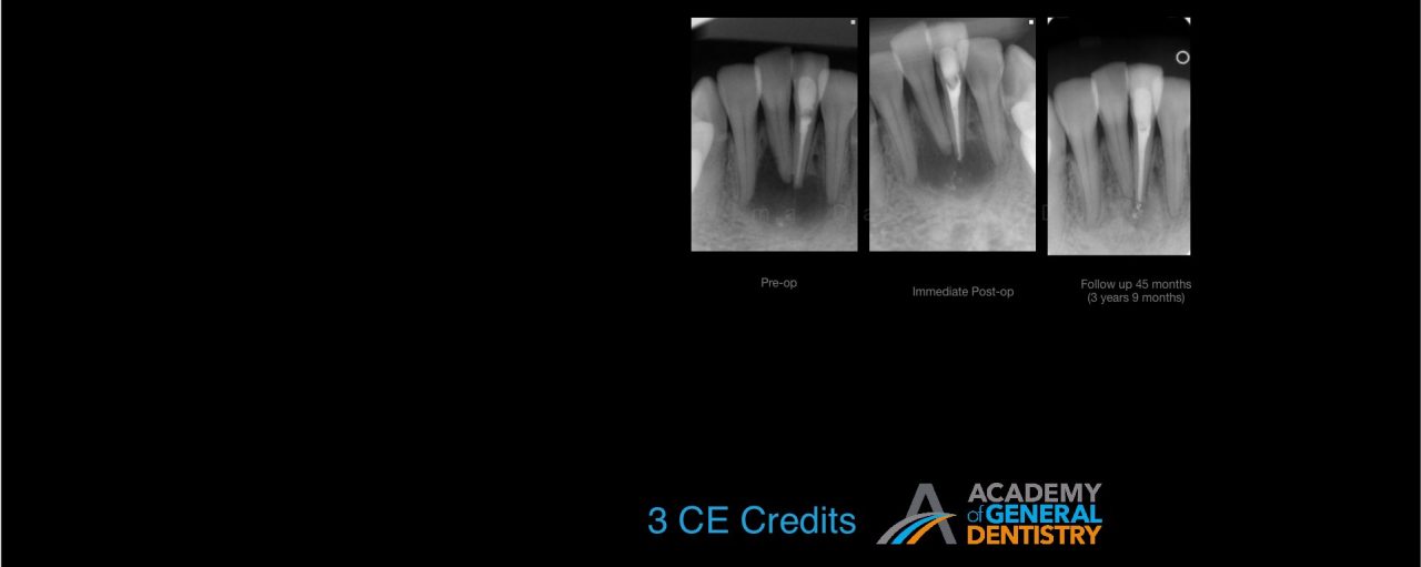 Why Do Endodontic Treatments Fail & How to Avoid Failures
